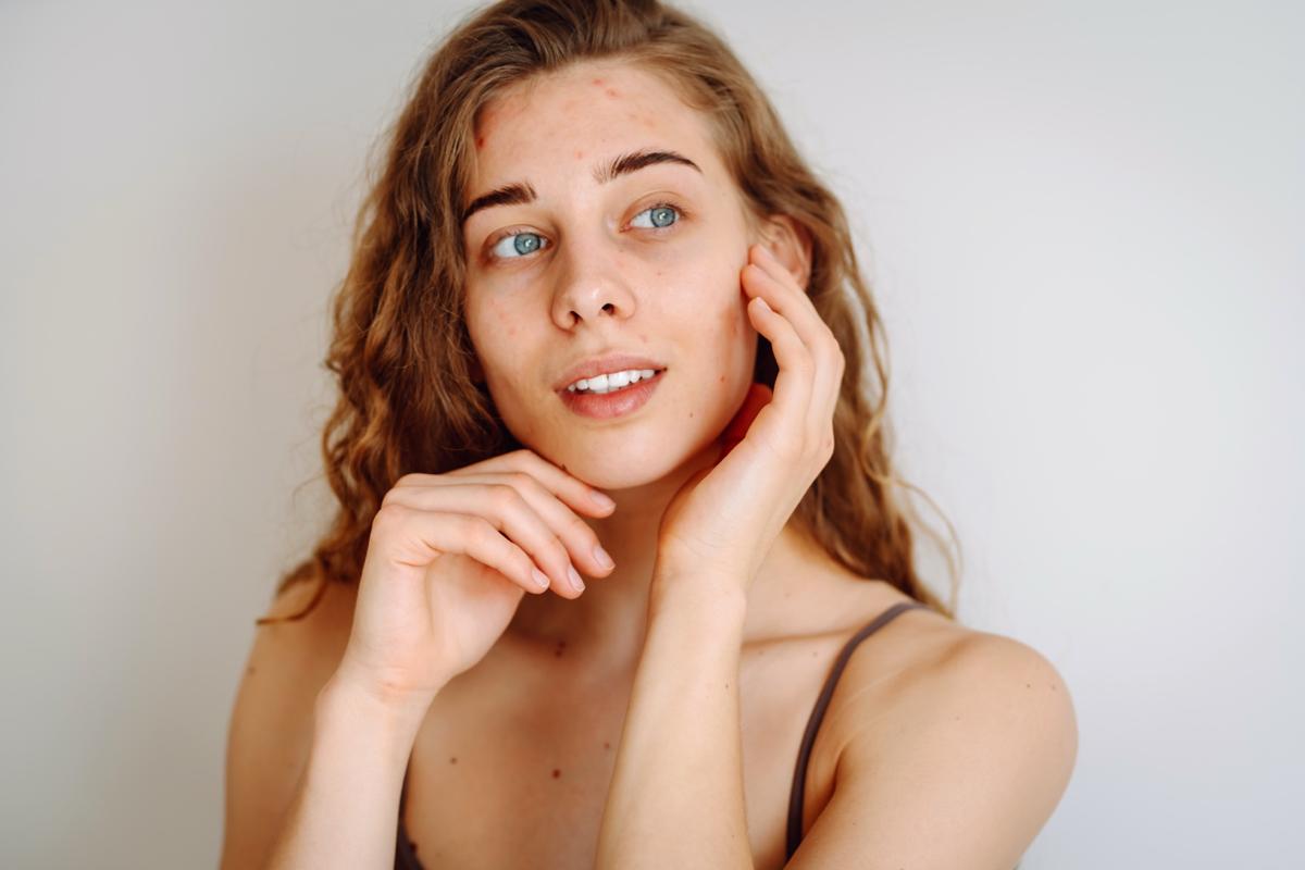 Schluss mit Akne- Die besten DIY-Rezepte